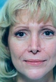 Juvederm to lips and NLF before 1581009