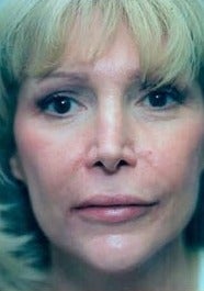 Juvederm to lips and NLF after 1581009