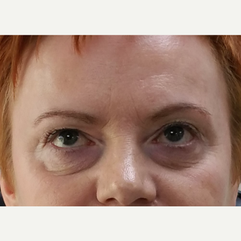 35-44 year old woman treated with dermal filler for tear trough before 2979369