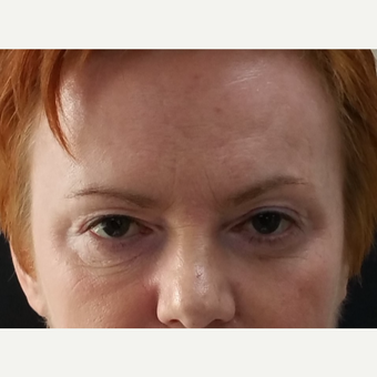 35-44 year old woman treated with dermal filler for tear trough after 2979369