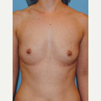 18-24 year old woman treated with Breast Augmentation before 2990250