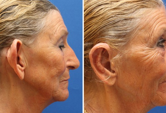 Ear Surgery before 1357695