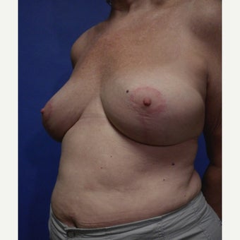 65-74 year old woman treated with ruptured gel Breast Implant Removal and reduction after 2635905
