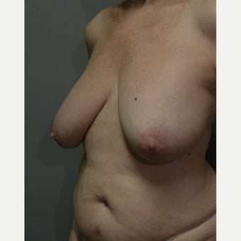 65-74 year old woman treated with ruptured gel Breast Implant Removal and reduction before 2635905