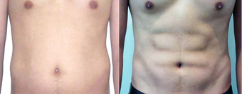 25-34 year old man treated with Vaser Liposuction before 4599297