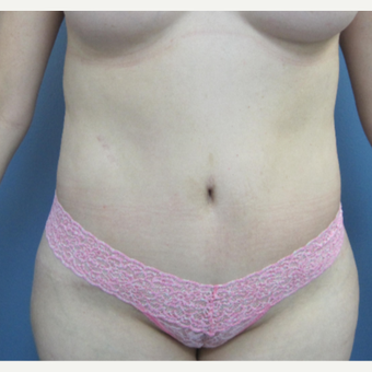 35-44 year old woman treated with Liposuction before 2993579