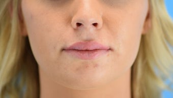 25-34 year old woman treated with Lip Augmentation 3624426