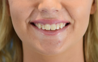 25-34 year old woman treated with Lip Augmentation after 3624426