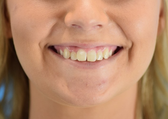 25-34 year old woman treated with Lip Augmentation before 3624426