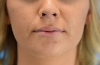 25-34 year old woman treated with Lip Augmentation 3624426
