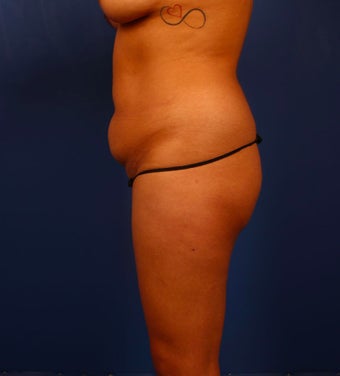 25-34 year old woman treated with Butt Lift before 3296798