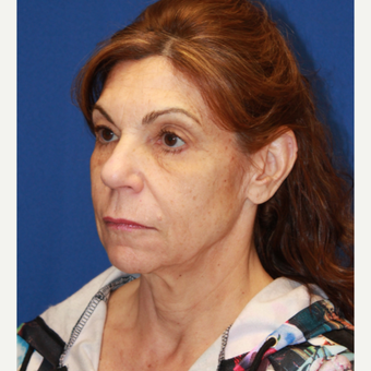 61 year old woman treated with CO2 Laser, Face/neck lift, fat transfer, Upper eyelids before 3320557