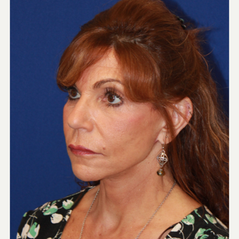 61 year old woman treated with CO2 Laser, Face/neck lift, fat transfer, Upper eyelids after 3320557