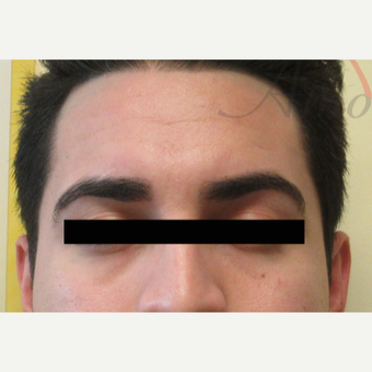 25-34 year old man treated with Eye Bags Treatment before 3771390