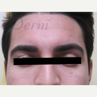 25-34 year old man treated with Eye Bags Treatment after 3771390