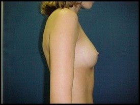 Breast Augmentation 470231