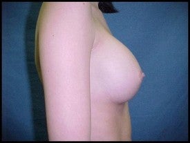 Breast Augmentation 470231