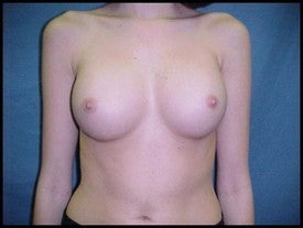 Breast Augmentation after 470231