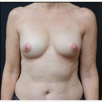 35-44 year old woman treated with Breast Implants before 3529796