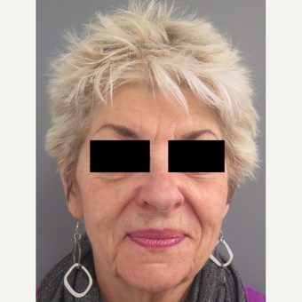 65-74 year old woman treated with Injectable Fillers after 3645854