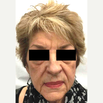 65-74 year old woman treated with Injectable Fillers before 3645854
