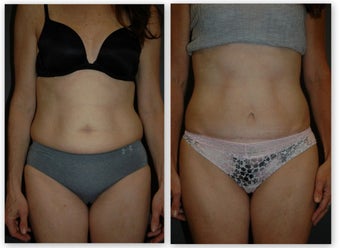 Abdominoplasty with umbilical float, (no incision around belly button) 881436