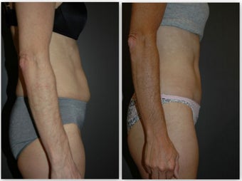 Abdominoplasty with umbilical float, (no incision around belly button) before 881436