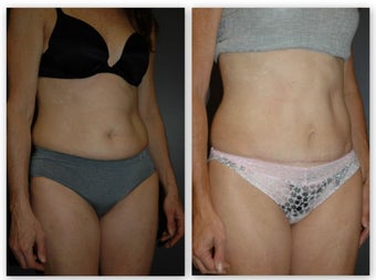 Abdominoplasty with umbilical float, (no incision around belly button) after 881436
