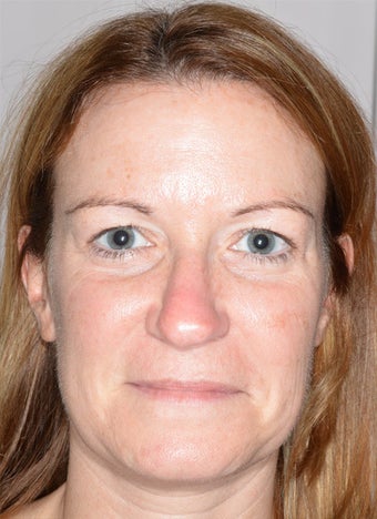 Intense Pulsed Light after 928655