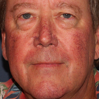 64 year old man was treated with Vbeam perfecta and the CoolTouch Varia before 3414065
