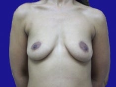 35 Year Old Female Had Breast Augmentation before 973699