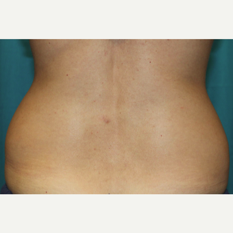 25-34 year old woman treated with CoolSculpting before 3588142