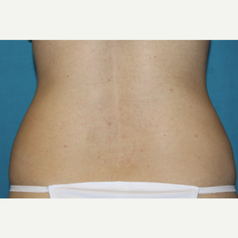 25-34 year old woman treated with CoolSculpting after 3588142