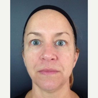 45-54 year old woman treated with Juvederm after 3060077