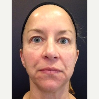 45-54 year old woman treated with Juvederm before 3060077