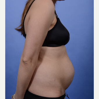 Tummy Tuck before 3052355