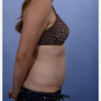 Tummy Tuck after 3052355