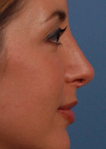 25-34 year old woman treated with Rhinoplasty after 2106960