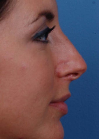 25-34 year old woman treated with Rhinoplasty before 2106960