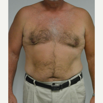 55-64 year old man treated with Male Breast Reduction after 3054052