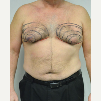 55-64 year old man treated with Male Breast Reduction before 3054052