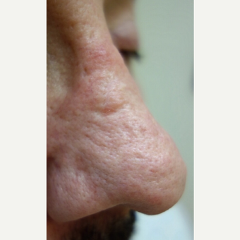 55-64 year old man treated with Dermabrasion before 3139460