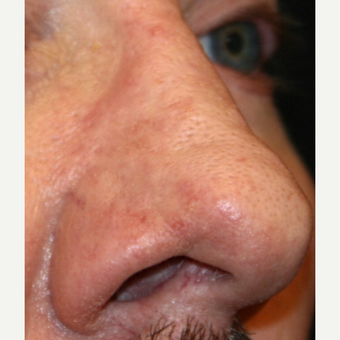 55-64 year old man treated with Dermabrasion after 3139460