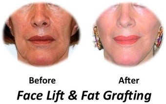 Facelift, fat transfer, skin resurfacing before 70156