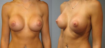 Breast Augmentation, Saline 360cc B to a Full C Cup after 129495