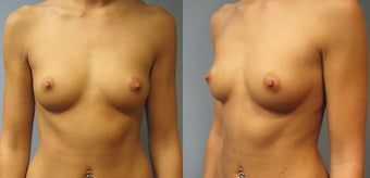 Breast Augmentation, Saline 360cc B to a Full C Cup before 129495
