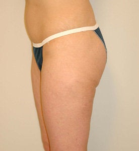 Power Assisted Liposuction before 70565