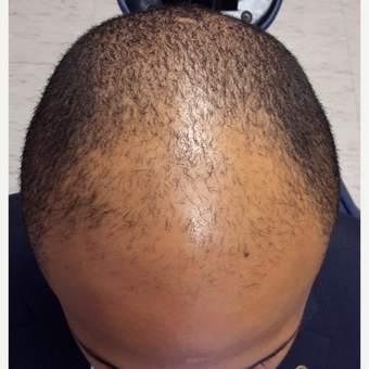 25-34 year old man treated with Hair Transplant before 3851516