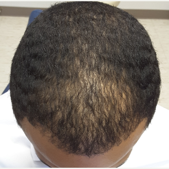 25-34 year old man treated with Hair Transplant after 3851516