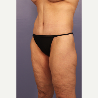 45-54 year old woman treated with Body Lift after 3666072
